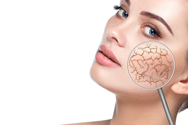 Nước cứng gây hại khiến da khô và dễ kích ứng