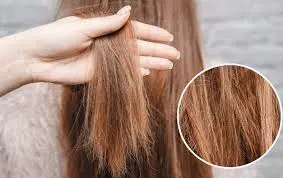 Nước cứng và bài toán viêm da kích ứng